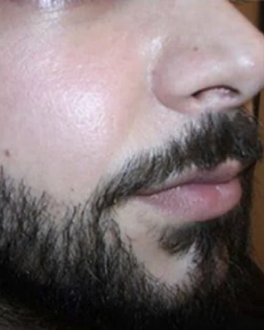 Greffe de Barbe — APRÈS