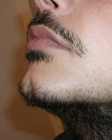 Greffe de Barbe — AVANT