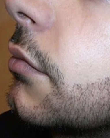 Greffe de Barbe — Premiers jours