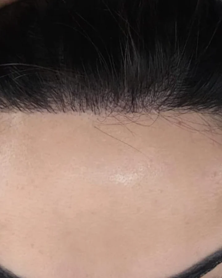 Greffe de Cheveux pour Femmes — APRÈS